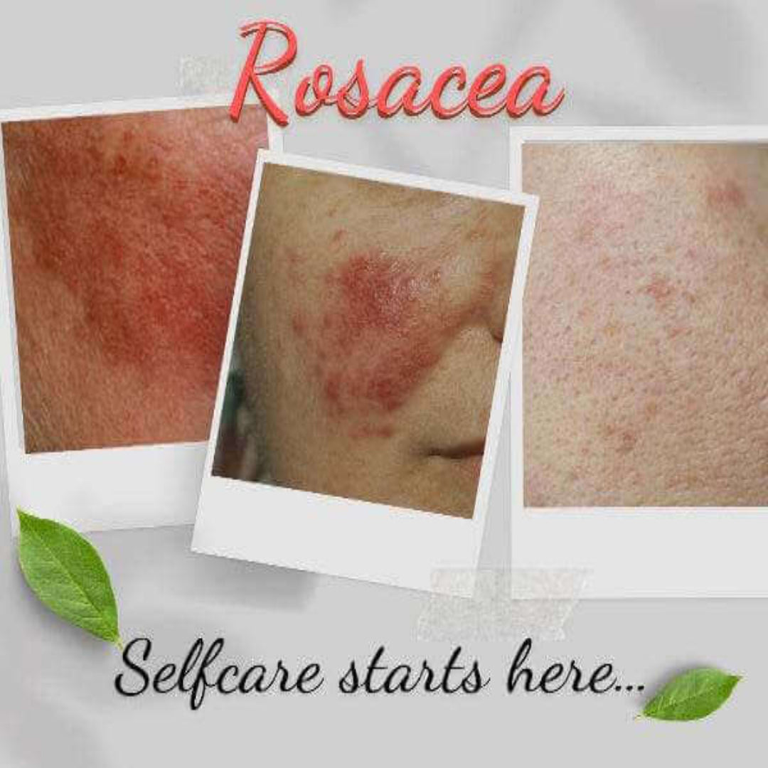 Organic Moisturizer for Rosacea Prone Skin - For Women & Men
